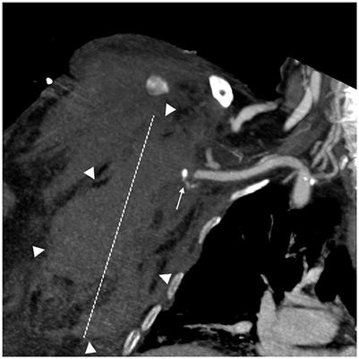 Case report: Spontaneous arterial bleeding in the lateral thoracic region during helmet CPAP treatment: a report of three cases in patients with severe COVID-19